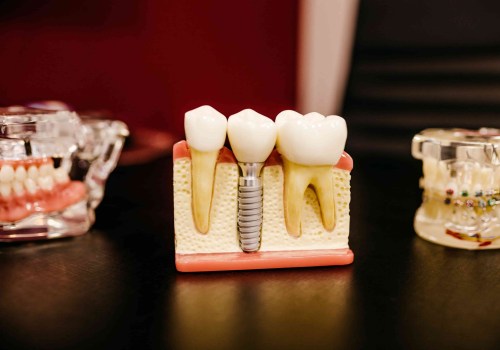 What are the Side Effects of a Tooth Implant