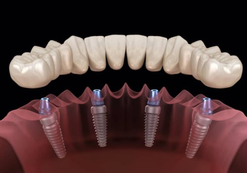 Which type of Dental Implants are Best